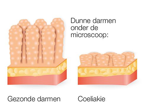 Gezonde darmen vs Coeliakie
